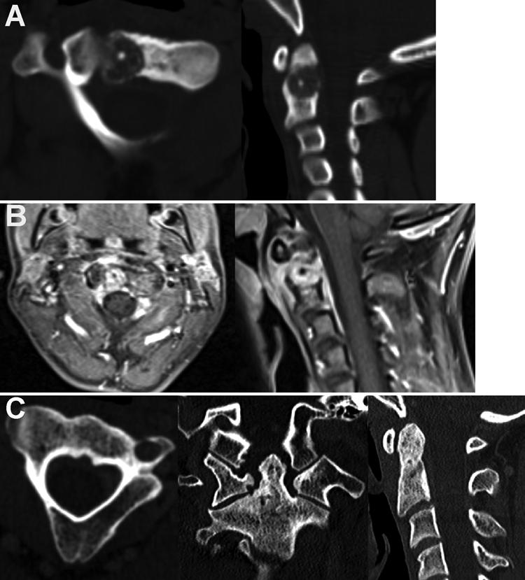 A. H. Menezes and R. Ahmed Fig. 3. Case 4. A 14-year-old (13 years of age at symptom onset) boy with osteoblastoma. A: Axial and sagittal CT scans.