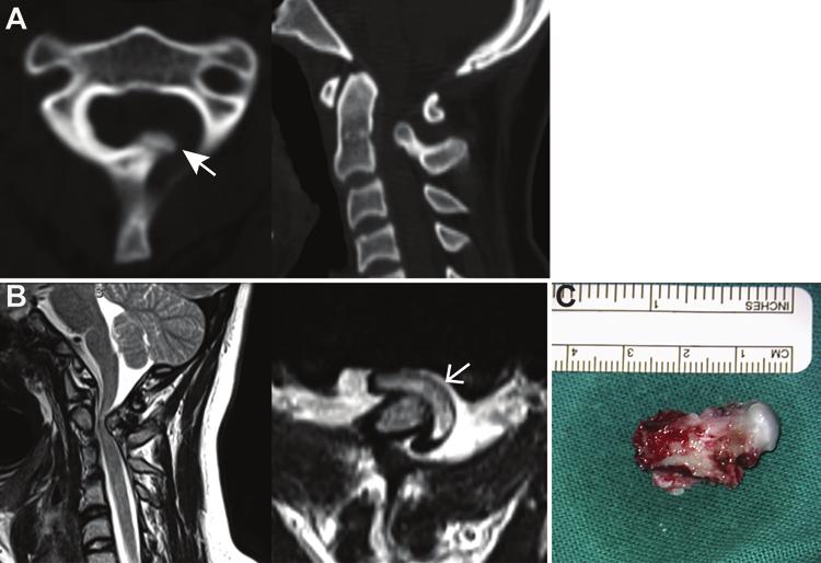 B: Midsagittal T1-weighted MR images before (left) and after (right) ventral trans oral resection.