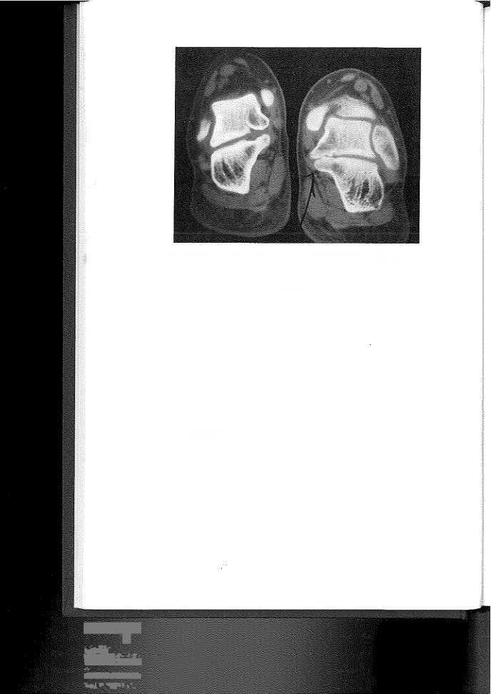 740 CLANTON & BERSON Figure 7. CT scan showing talocaicaneal coalition in 19-year-old tennis player. immobilization.