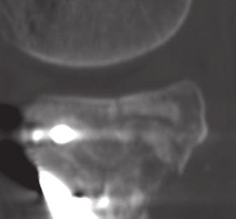 Three of these patients underwent reoperation with an average articular depression of 6.4 mm.