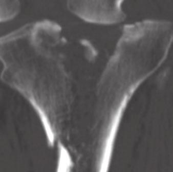 Postoperative MDCT of Tibial Plateau Fractures MDCT is affected by the composition and orientation of orthopedic hardware, acquisition parameters, and reconstruction parameters [8, 13, 14].