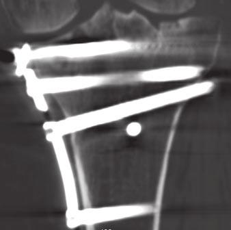 With correct adjustments, MDCT can be accurate in the assessment of bony structures, fracture healing, and postoperative complications, which are not always well visualized on radiographs of patients