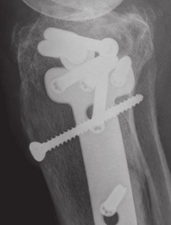 Whereas MDCT has become increasingly important in the primary diagnosis of knee trauma, for postoperative and follow-up imaging, MDCT continues to be a problemsolving tool used sparingly.