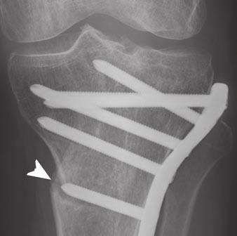 Mustonen et al. Fig. 3 54-year-old woman with tibial plateau fracture (O/OT type C3, Schatzker V) due to traffic injury.