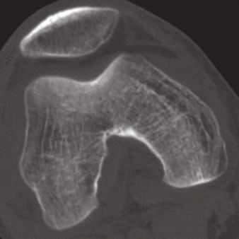 17]. t radiography, in contrast, orthopedic hardware, plates specifically, severely impairs the visibility of joint surfaces and of often obscure fracture lines.