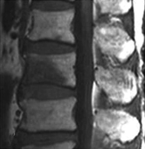 SI : signal intensity, VCF : vertebral compression fracture. A B C Fig. 2. The vertebral deformity types of the follow up MRI.