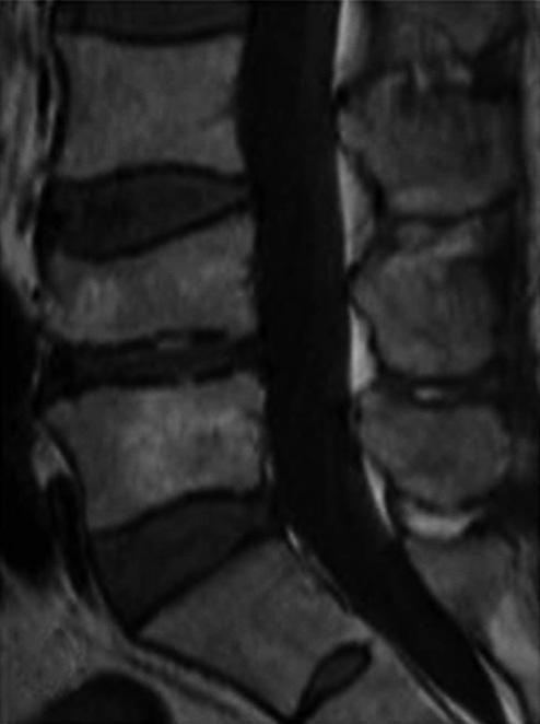 The fluid sign was defined as the collection of intravertebral fluid, which appears as an area of low SI on T1WI and high SI on T2WI, adjacent to the fractured vertebral endplate.