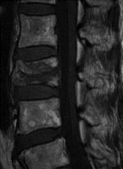 body. B : Sagittal T1WI of follow up MRI taken after 4 months shows anterior wedge deformity of VCF at the L3 vertebral body and crush deformity of VCF at the L5 vertebral body.
