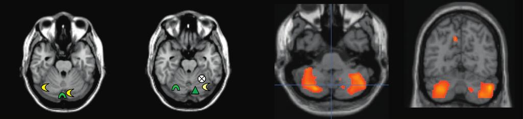 Activation (white) in the basal ganglia and the cerebellum correlates with temporal difference prediction error. Adapted, with permission, from [75].