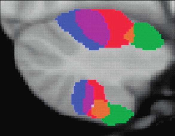 evoked by stimulation. (B) Somatomotor topography in the cerebral cortex related to the foot (green), hand (red), and tongue (blue). Left hemisphere shows sites of fmri activation during motor tasks.