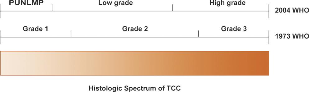 european urology 51 (2007) 889 898 891 Fig. 2 Comparison of the 1973 and 2004 WHO grading system.