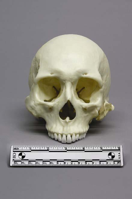 Human Healed Trauma Skull Product Number: Specimen Evaluated: BC-303 Original Specimen Skeletal Inventory: 1 Cranium with full dentition (teeth ##1-16) 1 Mandible with full dentition (teeth ##17-32)