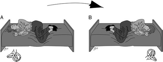 " Otolaryngol Head Neck Surg 107(3): 399-404. Epley, J. M. (1992). "The canalith repositioning procedure: for treatment of benign paroxysmal positional vertigo.