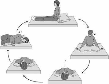 Self-Canalith Repositioning Procedure illustrated for treatment of right PC. Self treatment Head is extended over edge of pillow. 3 cycles of exercise 3 times per day.