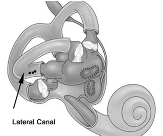 Horizontal DCPN Mechanism of lateral canal BPPV:
