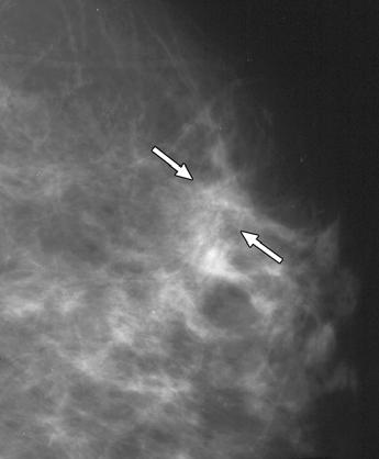 CAD Versus Human for Second Reading in Screening Mammography A C Taplin et al. [14], who showed that the average increase in sensitivity with double reading was 7%.