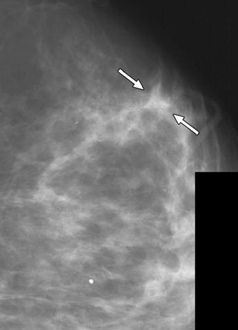 However, note that the CAD system marked those two cases found by the human second reader and marked the one case of interval cancer considered by consensus to have detectable mammographic findings,