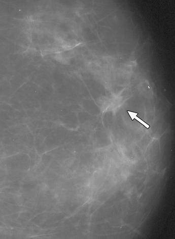 Those investigators retrospectively reviewed the screening mammograms of patients with findings interpreted as negative who developed interval cancers.