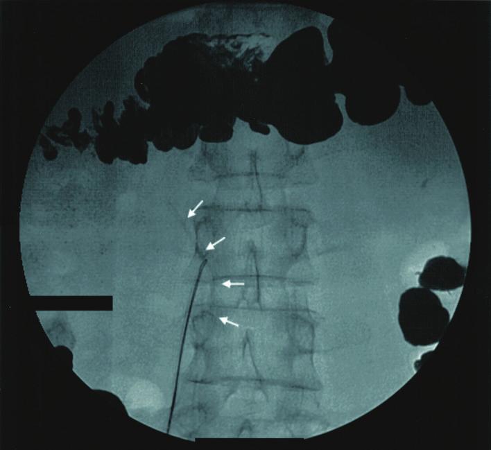 The dislodged segment of Port-A catheter can be depicted by mindful inspection of scout image (arrows), which reminds us that scout image sometimes contains clinically important information.
