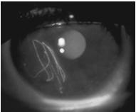 Corneal Foreign Body