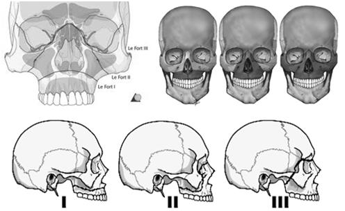 Associated Facial Fractures Zygomatico Facial Complex (zmc) Fractures Maxilla from palate Maxilla from face Face from cranium