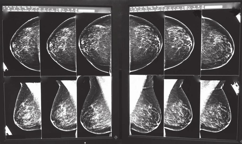 Comparing Screening Mammograms With Multiple Prior Mammograms some of these studies have shown that comparison with a prior mammogram also increases the biopsy yield of cancer (i.e., the chance that a biopsy specimen will include cancerous tissue), although none have shown an increase in the cancer detection rate (CDR) [5 12].
