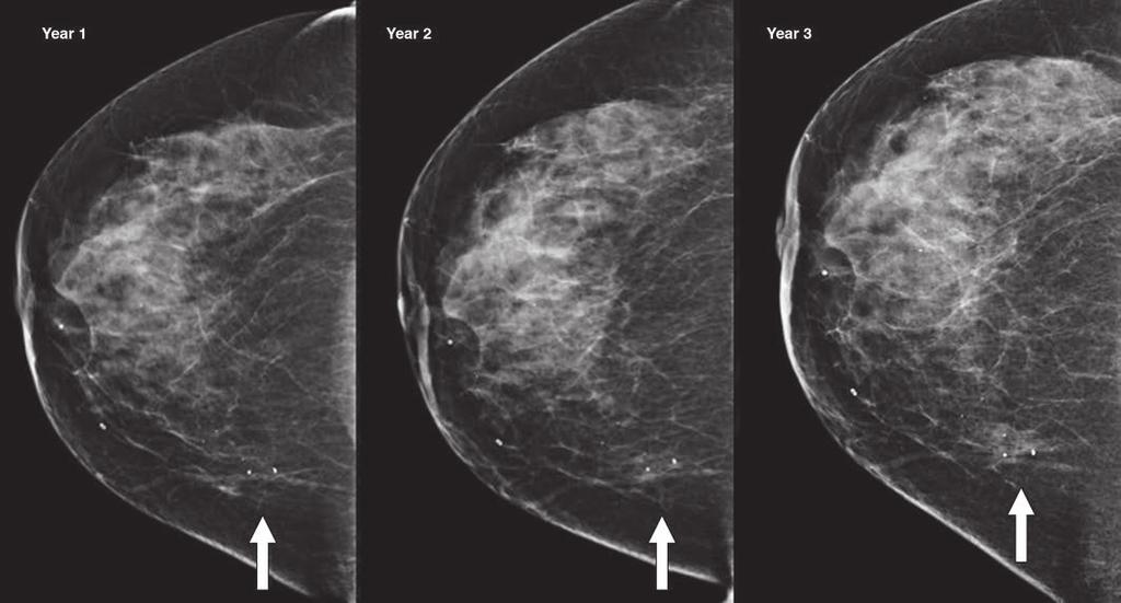 Comparing Screening Mammograms With Multiple Prior Mammograms Fig. 3 75-year-old woman with infiltrating ductal carcinoma of right breast presenting as developing asymmetry (arrows) in medial breast.