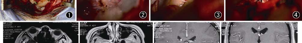Figure 6. Postoperative MRI image in transverse section. Figure 7. Preoperative MRI image in coronary section. Figure 8. Postoperative MRI image in coronary section.