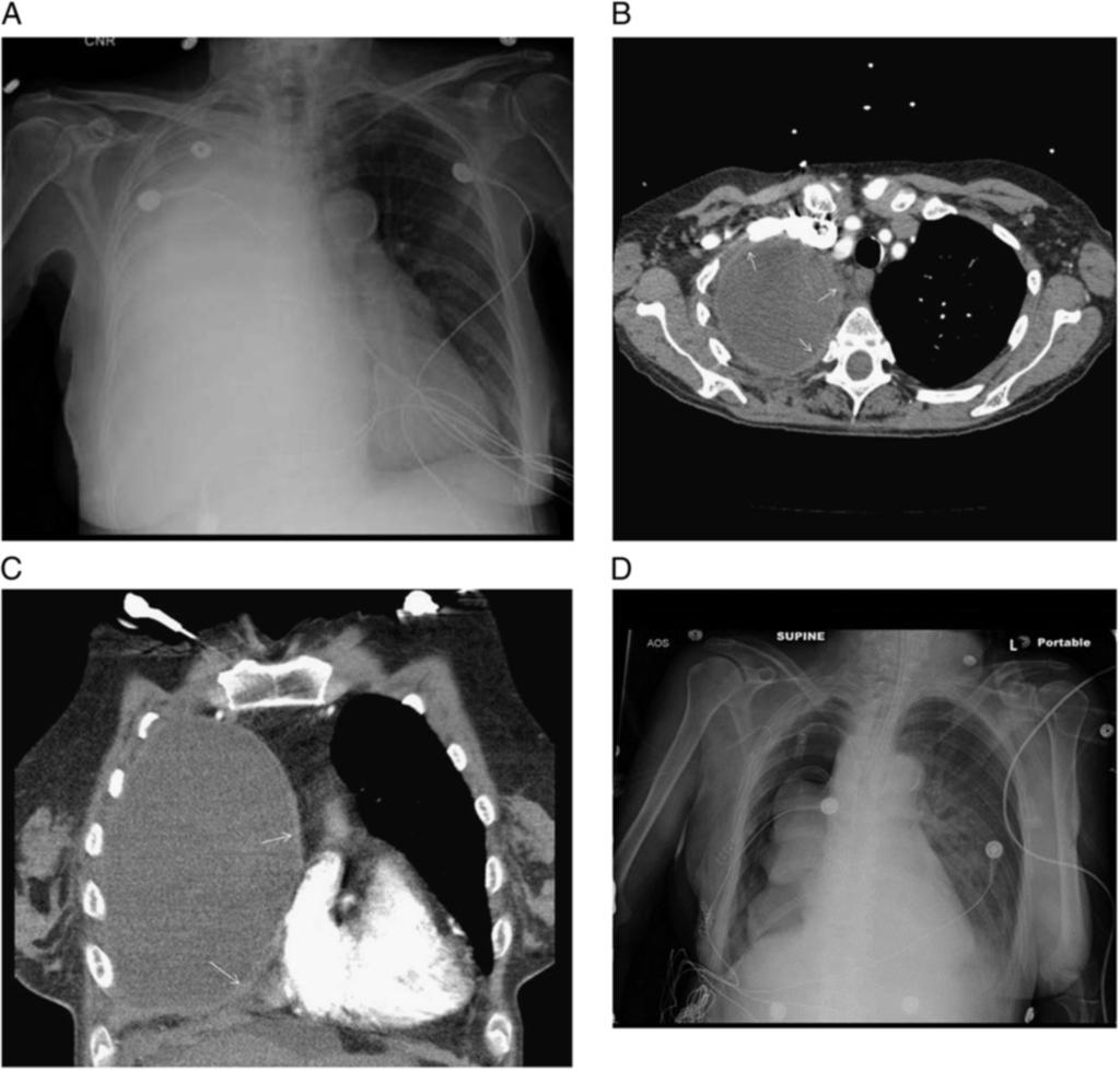 Figure 1. A, Complete opacification of right-side lung. B, CT scan showing large right-sided pleural effusion and pleural thickening (white arrows).
