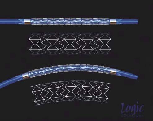 PATENCY The Cook Logic PTX stent (n=5) Coating applied to abluminal surface