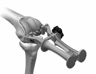 Attach the Femoral and Provisional Impactor/Extractor to the correct Provisional/Cut Guide by inserting the tabs on the inserter arm into the notches in the provisional/cut guide and tighten the knob