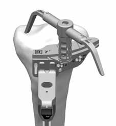 Depress or rotate the black button on the proximal portion of the EM Distal Telescoping Tube to position the Tibial Depth Resection Stylus and the Captured Cut Guide to the desired level. Insert 3.