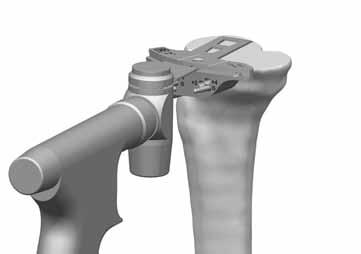 Resect Proximal Establish Tibia without the Tibial Spike Platform Arm 1 6A Resect Proximal Tibia Push the black button on the anterior proximal portion of the Alignment Guide assembly to remove the