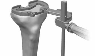Size and Establish Position the Tibial Tibial Component Platform 1 8B TECHNIQUE TIP 8.G Do not impact or lever the Offset Sizing Plate Handle; this instrument is designed for alignment purposes only.