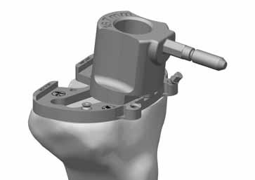 81 Assemble the Tibial Broach Impactor to the correct-sized Stemmed Tibial Broach, by retracting the locking button on the impactor, inserting the broach and