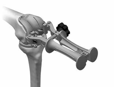 With the knee in 70-90 of flexion, place the Collateral Retractor laterally, an Army-Navy retractor anteriorly,and a rake retractor on the meniscal bed medially.
