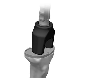 11 1 Establish Implant Components the Tibial Platform Tibial Plate If a stemmed tibial base plate will be used with a stem extension, attach the desired stem extension to the stem and strike it once