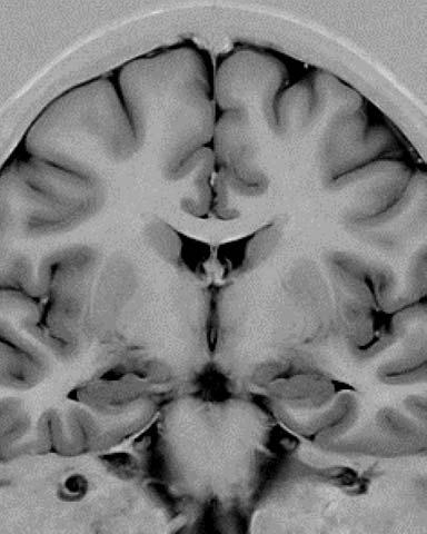 2875 Fig. 17 Coronal slice through the brain acquired with a turboir sequence.