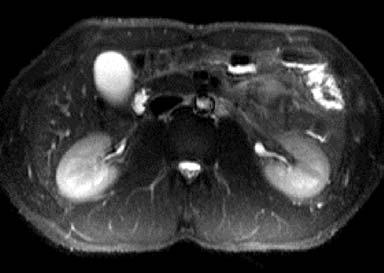 23 A so-called magnetic resonance cholangiopancreatography (MRCP) maximum intensity projection of a heavily T2-weighted coronal HASTE acquisition showing biliary stones and a dilated duct.