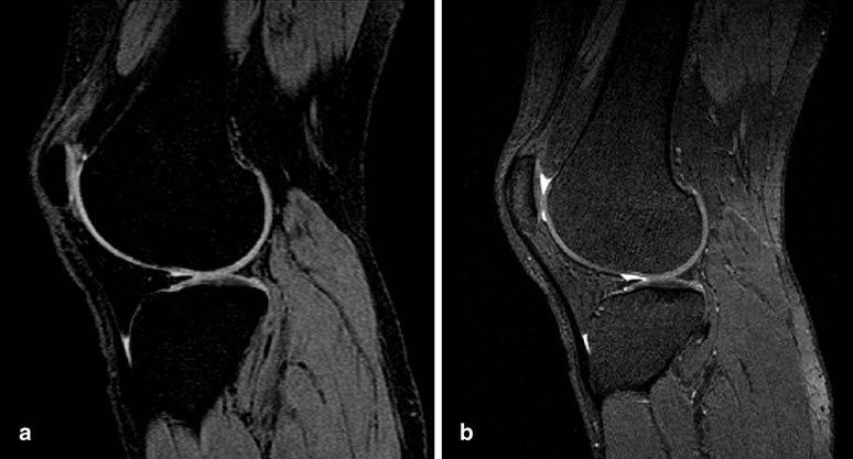 2879 Fig. 26 a This knee study was acquired with a sequence of type FISP with a spectral fat saturation pulse.
