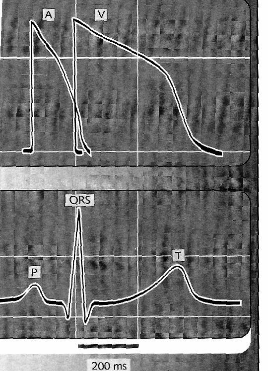 Electrophysiological changes K + loss normal EKG