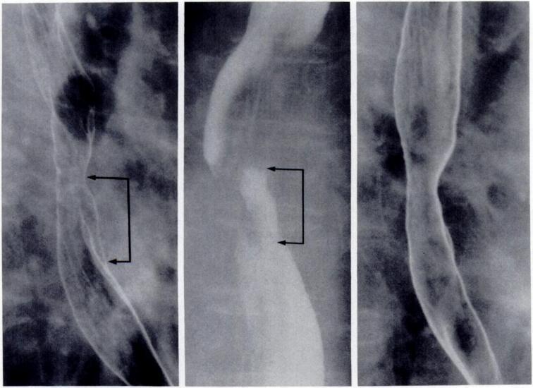 Long circumferential ulcer (between arrowheads) in field of both external and intracavitary irradiation, but only mucosal change without ulceration