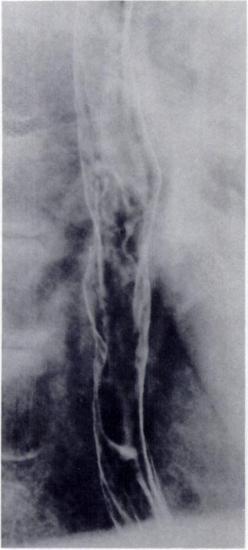 272 HISHIKAWA ET AL. AJR:143, August 1984 A B C C x Ui Gy 7 6 4 oo (. +. Fig. 4-73-year-old rnan. A, After completion of external irradiation of 4 Gy. Deep ulcer on posterior wall of esophagus.