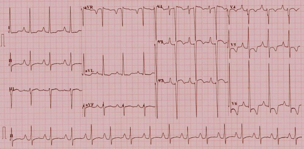 EKG: Superior QRS axis (0 to -90 degrees), LVH Treatment: Prostaglandins if severe cyanosis