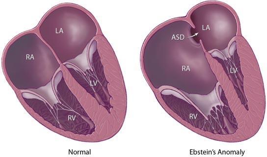 Pathology: Apical displacement of the tricuspid valve, so that a portion of the RV is