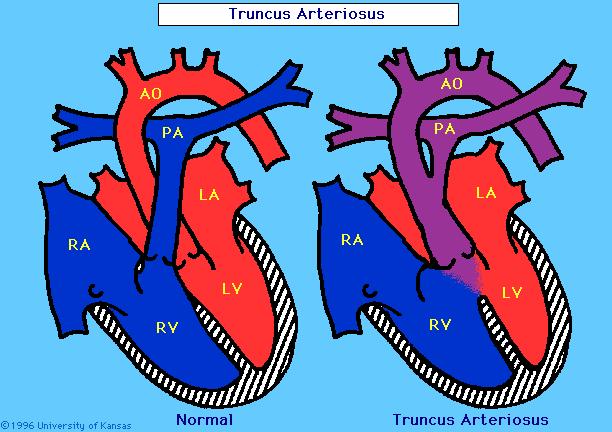 Pathology: A single arterial trunk with a truncal valve exits the heart and gives rise to the