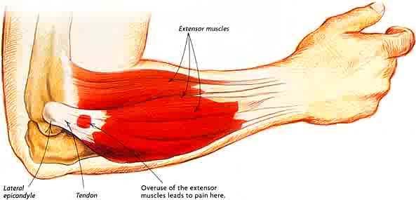 Lateral Epicondylitis Or Tennis Elbow. This affects the lateral side of the elbow. Becomes painful and tender. Idiopathic, self limiting, often in middle age (35-60) and resolves in about a year.