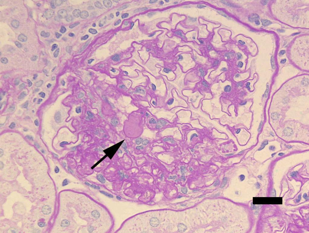 Diabetic Nephropathy in Spontaneously Diabetic Torii (SDT) Rats The Open Diabetes Journal, 2011, Volume 4 47 The histologic features are diffuse and/or nodular glomerulosclerosis and hypertension is