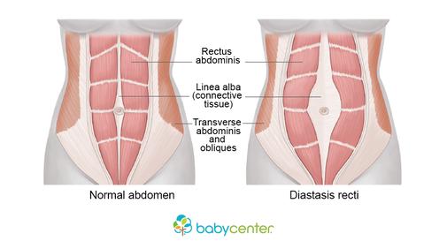 Anatomical Description Diastasis Recti Diastasis Recti is the separation of the Rectus Abdominis muscles.