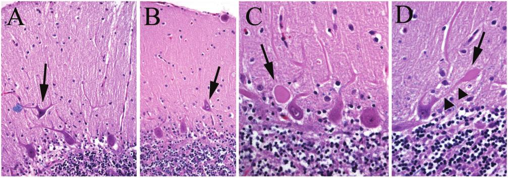 Pathology of essential tremor Brain (2007), 130,3297^3307 3303 Fig. 3 Purkinje cell heterotopias and dendrite swellings in cerebellum from an ET case. LH&E-stained cerebellar cortical sections.